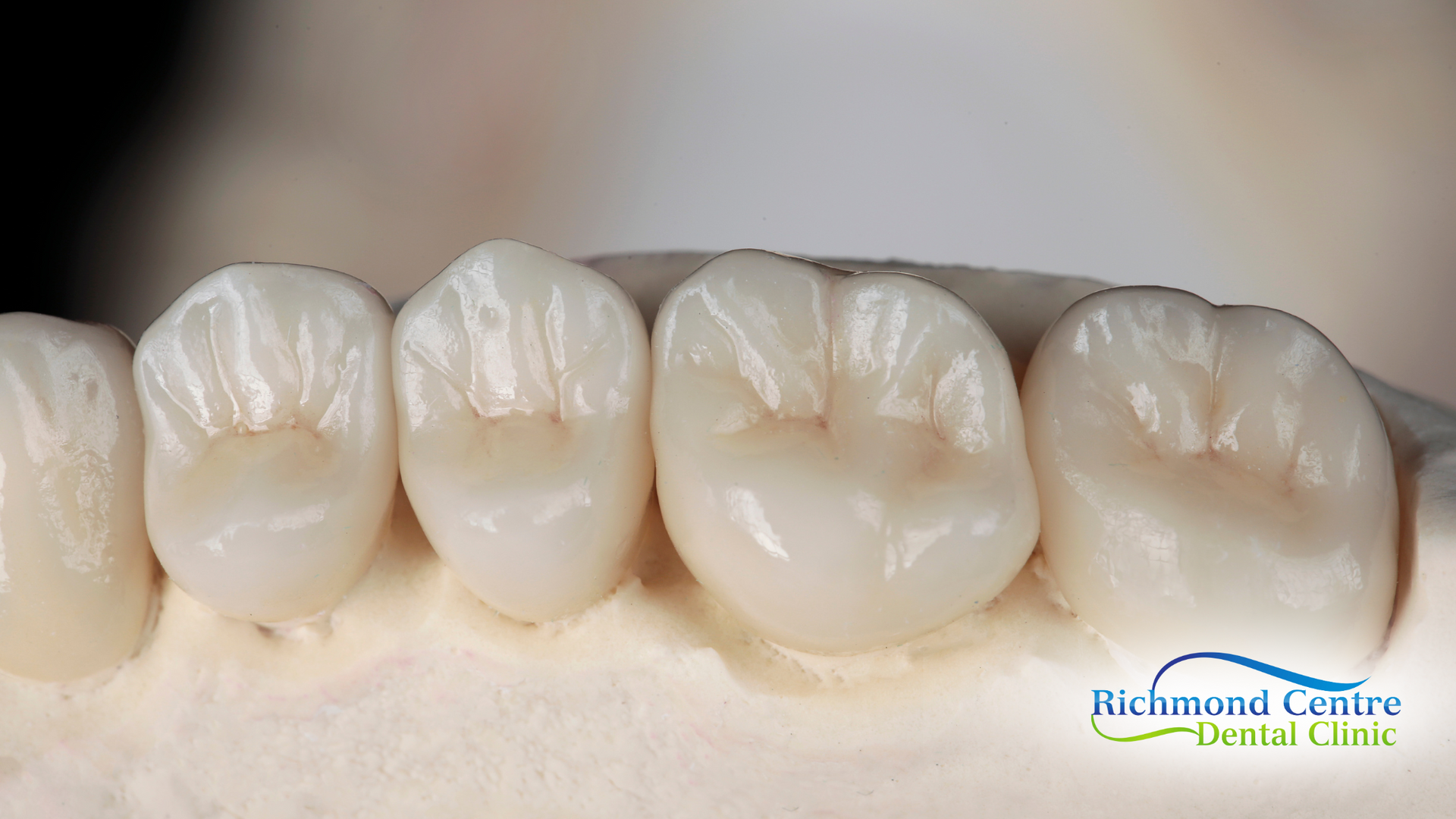 A close up of a model of a person 's teeth.